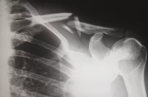Fracture 1