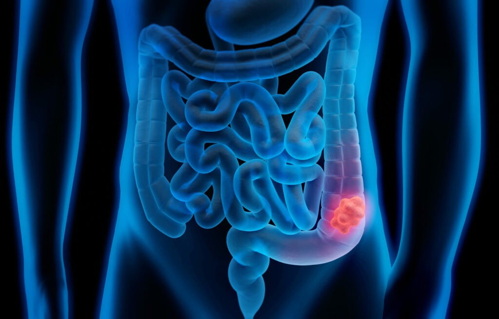 Darmpolyp